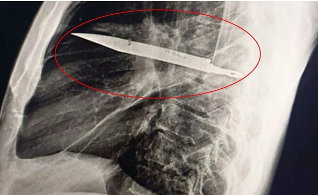 Tanzaniyada kişi xəbəri olmadan səkkiz il sinəsində bıçaqla yaşayıb