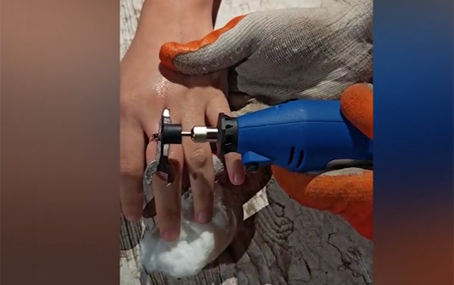 Qızın barmağında qalan üzüyü belə çıxardılar - Video