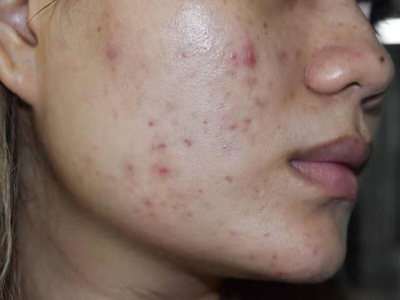 Bu qidalar üzdə sızanaq yaradır