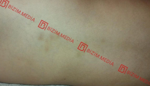 Lənkəranda qandonduran HADİSƏ – Ana isti qaşıqla 3 yaşlı qızının qolunu DAĞLADI