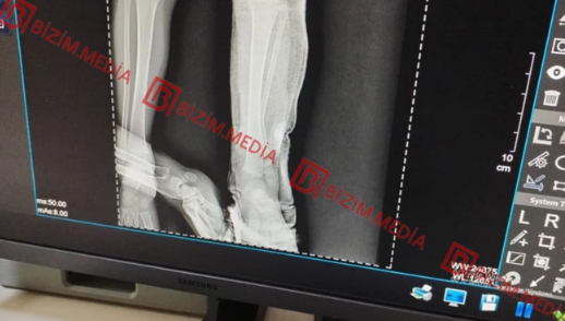 Lənkəranda qandonduran HADİSƏ – Ana isti qaşıqla 3 yaşlı qızının qolunu DAĞLADI