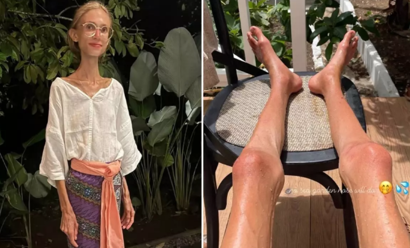 Meyvə pəhrizi ilə 20 kilo arıqlayan sosial media fenomeni dünyasını dəyişdi