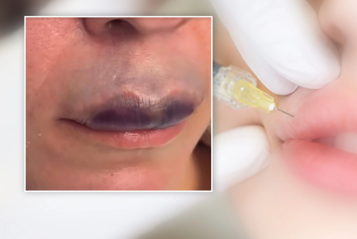 Azərbaycanda daha bir qadın estetik əməliyyatın qurbanı oldu - Dodağı göyərdi