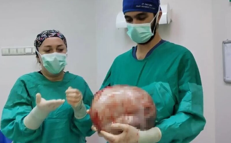 Gənc qadının qarnı 2 ayda 9 aylıq hamilə kimi böyüdü, həkimlər əməliyyata aldı