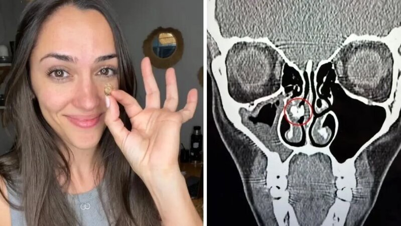 35 il sonra ortaya çıxan həqiqət: Burnundan çıxan şey təəccübləndirdi