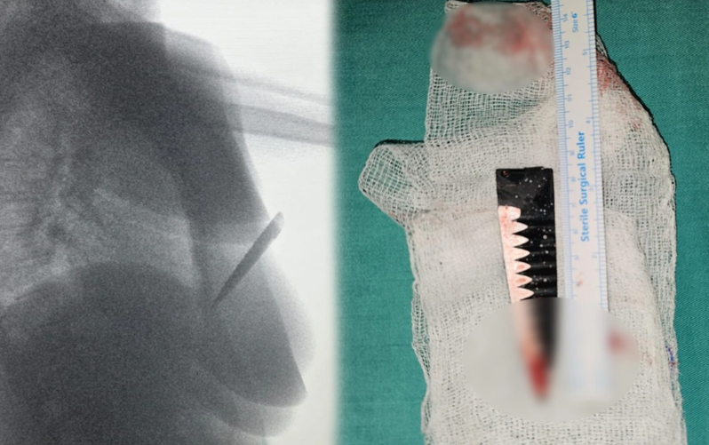 Toydan çıxarkən bıçaqlanan davulçu sabiq sevgilisindən şikayətçi, həyatından narahatdır