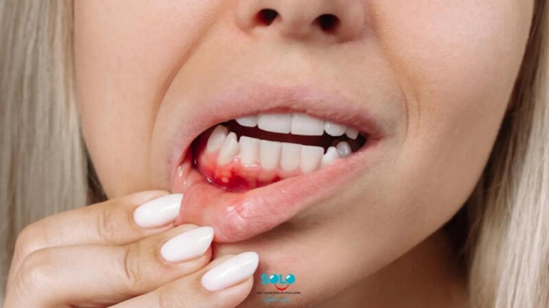 Sadə görünür, amma təhlükəlidir - Diş əti qanaması nəyin xəbəridir?