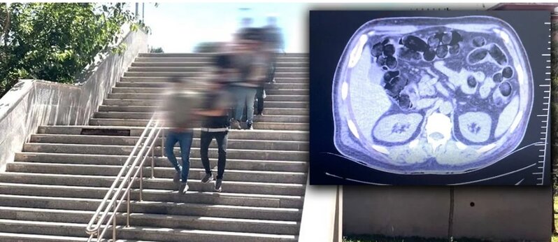 Türkiyədə əməliyyat: Əcnəbi sərnişinlərin mədəsindən 2.7 kiloqram narkotik aşkarlandı