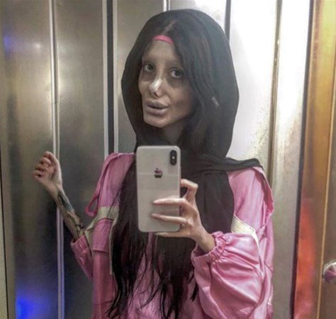 Coliye bənzəmək üçün onlarla əməliyyat etdirən fenomenin 10 il öncəki ŞOK HALI - FOTOLAR