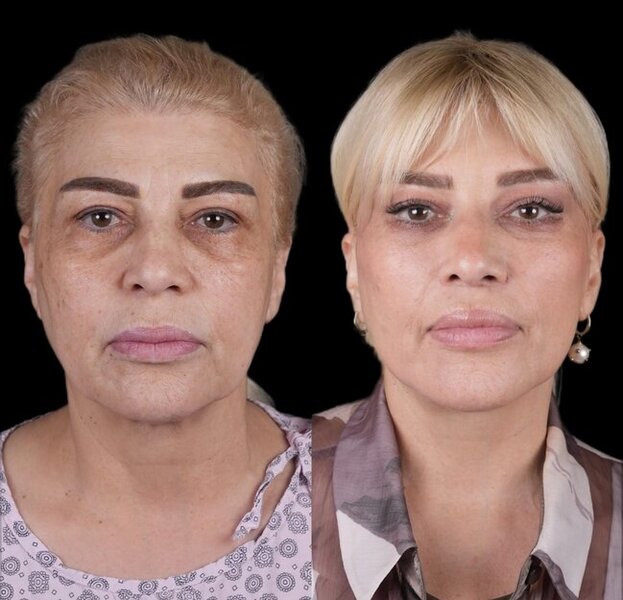 Mətanət İsgəndərli əməliyyatla dəyişdi - FOTO