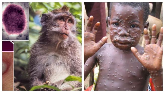 "Meymunçiçəyinin Azərbaycana gəlib çatma ehtimalı var" - İnfeksionist