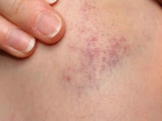 Dəridə bu iki simptom qaraciyərin xəstə olduğunu göstərir