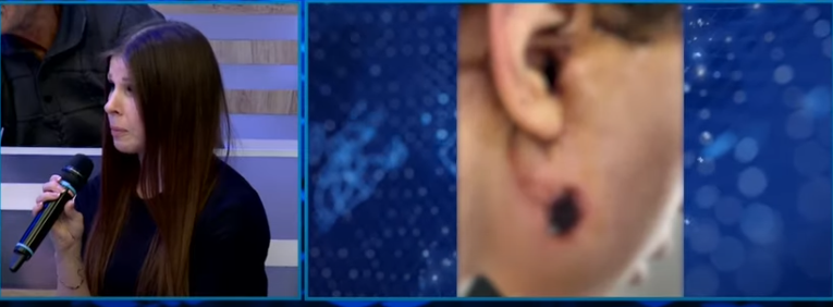 Azərbaycanlı plastik- cərrah rusiyalı qadının üzünü və qulağını YANDIRDI- FOTOLAR