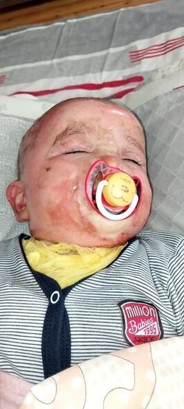 İki yaşlı körpənin başından qaynar su tökülüb: Müalicəsinə 500 manat pul tapmırlar - FOTO