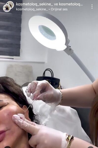 Kosmetoloq Səkinə Zamanova necə inyeksiya, dolğu proseduru həyata keçirir?-Fotofaktlar