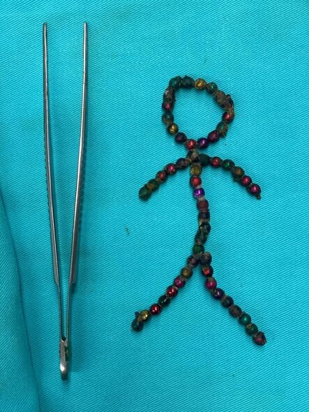 Bakıda azyaşlı uşaq 53 maqnit udub - FOTO