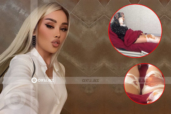 Gecə klubunda xəsarət alan modelin görüntüləri – FOTO