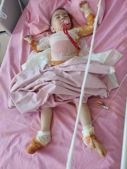 Bir yaşlı İnci anası süd qızdıran zaman yanıb - FOTO