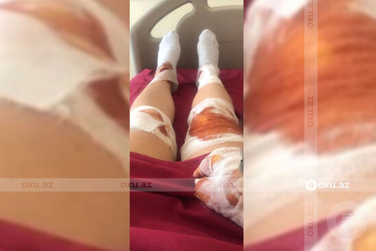 Gecə klubunda xəsarət alan modelin görüntüləri – FOTO