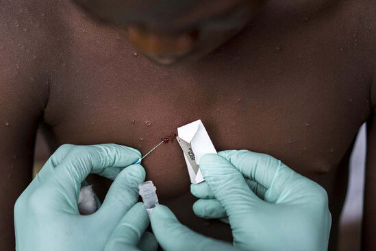 Dünyada neçə nəfər "meymun çiçəyi"nə yoluxub? - ÜST AÇIQLADI