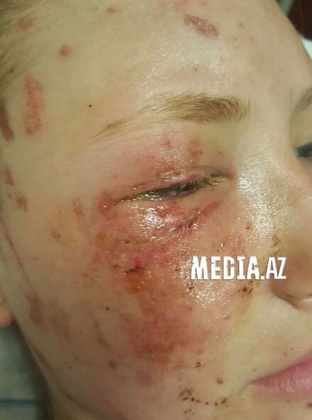 Şamaxıda qəzada xəsarət alan məktəblinin anası: "Zərbə qızımı avtobusun ön şüşəsindən atıb" - FOTO