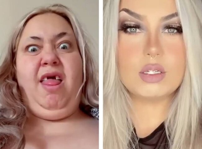 Dişsiz "çirkin ördəkdən" gözələ çevrilib söyüldü - FOTO-VİDEO