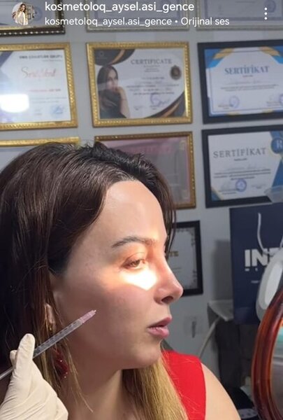 Gəncədə "ixtisaslaşmış kosmetoloq" Aysel Süleymanova tibbi sertifikatı və lisensiyası olmadan necə fəaliyyət göstərir?