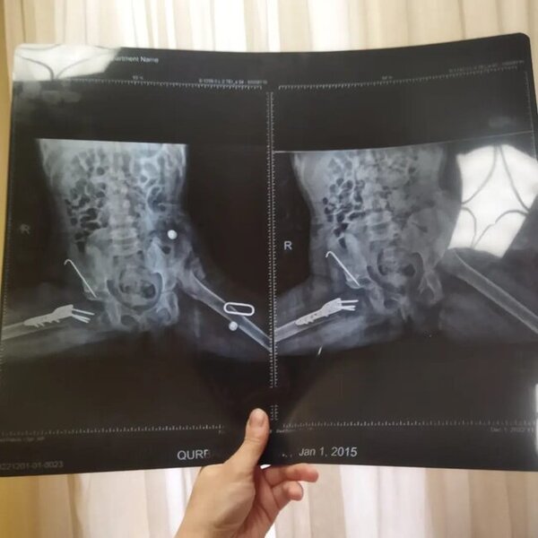 Balaca Aytəndən ŞAD XƏBƏR: Əməliyyat olundu - FOTO-VİDEO