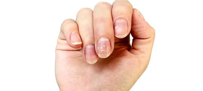 Çinko çatışmazlığı nələrə səbəb olur - problemi aradan qaldırmağın yolları