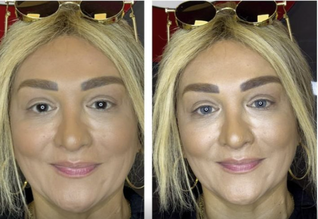 Azərbaycanda göz rənginin dəyişdirilməsi qadağan ediləcək? - ARAŞDIRMA