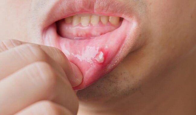 Adi yara bilirdi, xərçəng çıxdı: 23 yaşlı qadın dilini itirdi