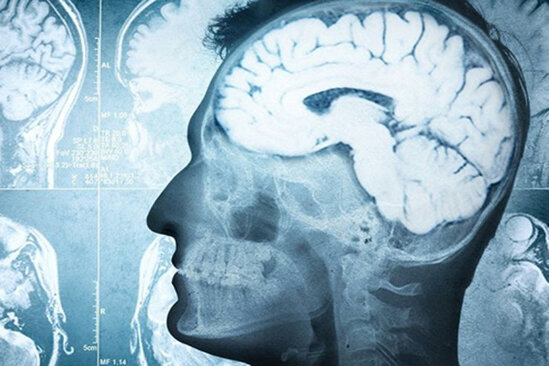 Tarixdə İLK DƏFƏ: Parkinson xəstəsi sağaldı