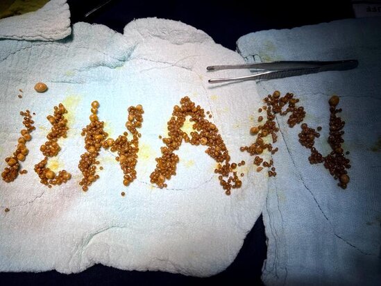 Öd kisəsindən 1250 daş çıxdı, həkim görün nə etdi - FOTO