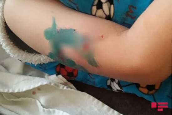 Tovuzda 10-dan çox şəxsi sahibsiz itlər dişləyib - FOTO