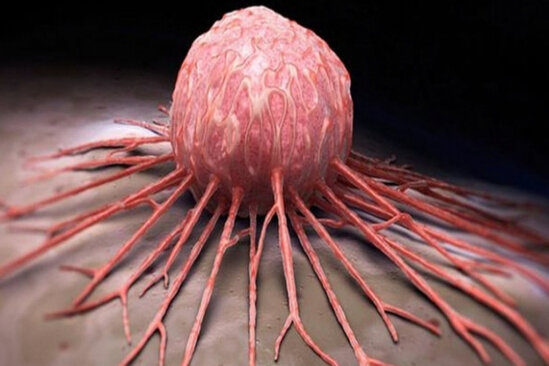 Çətin müalicə olunan xərçəng şişləri belə məhv ediləcək – YENİ KƏŞF