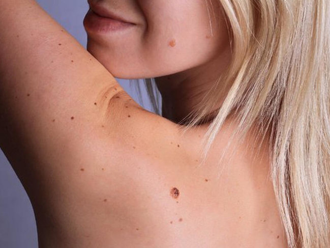 Problemli ət xallardan sadə vasitə ilə xilas olun