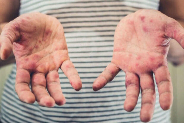 Hepatit A xəstəsi xəstəxanada qızılcaya yoluxub? - TƏBİB-dən AÇIQLAMA