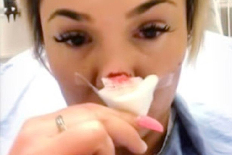 Kişi cehizə görə arvadının burnunu dişlədi