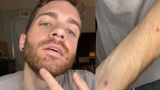 Xəstəlikdən sağalan məşhur aktyor meymunçiçəyi ilə bağlı təcrübəsini bölüşdü - FOTO/VİDEO