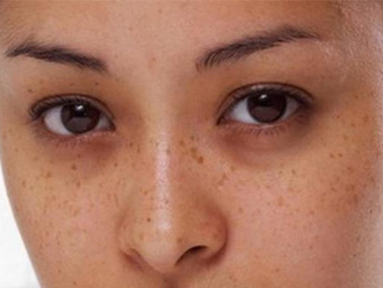 Göz altı torbalarınızdan təbii üsullarla qurtulun