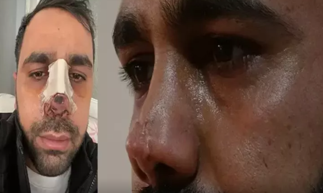 İkinci dəfə estetik əməliyyat olunan kişinin burnu çürüdü
