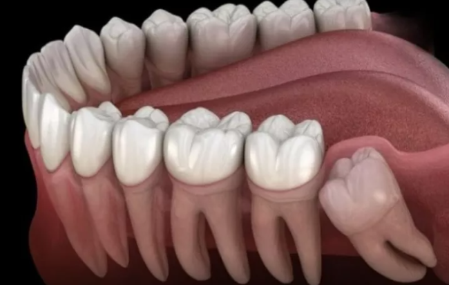 Bütün insanların ağıl dişləri olmur - Onlar nəyə lazımdır?