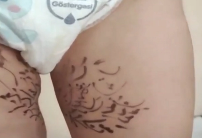 Azərbaycanda RƏZALƏT: Dəmrov xəstəliyini sağaltmaq üçün mollaya körpənin ayağına dua yazdırdılar