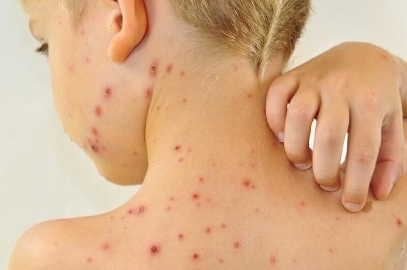 Azərbaycanda qızılca kabusu - Yoluxma sayı 2 mini ötərsə...