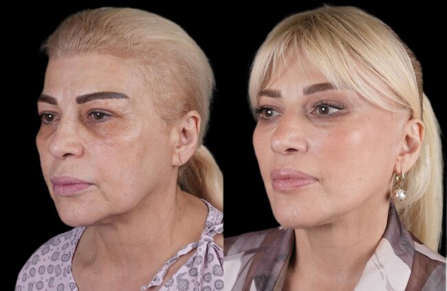 Mətanət İsgəndərli əməliyyatla dəyişdi - FOTO