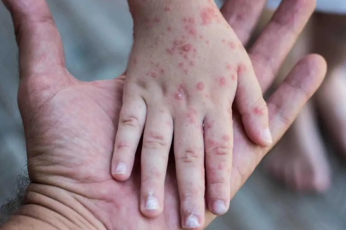 Qızılcaya təkrar yoluxmaq mümkündürmü? – ARAŞDIRMA VİDEO