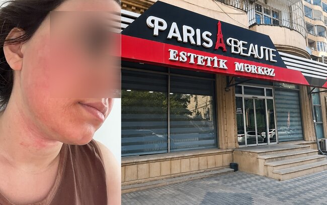 "Lazeroloq üzümü yandırıb..." - Foto
