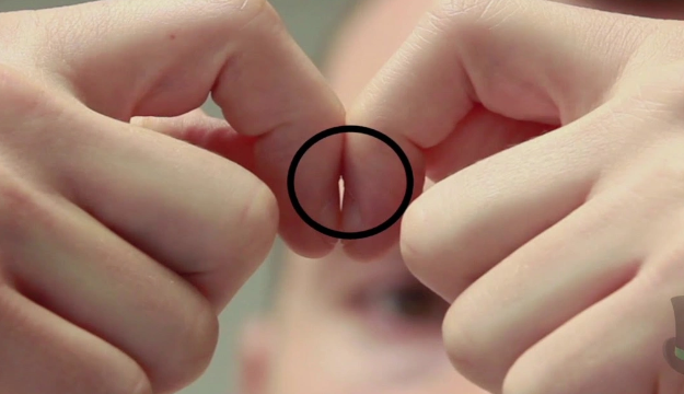 Ağciyər xərçənginin gizli əlaməti - Barmaq uclarına diqqət yetirin