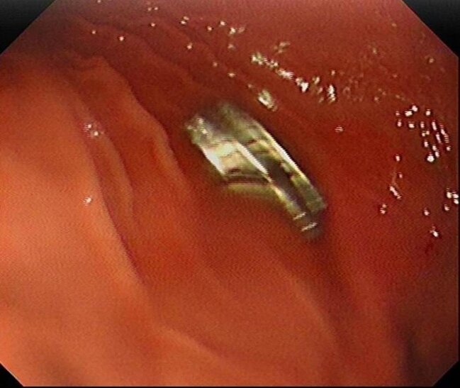 3 yaşlı uşağın boğazından 19 maqnit çıxarıldı