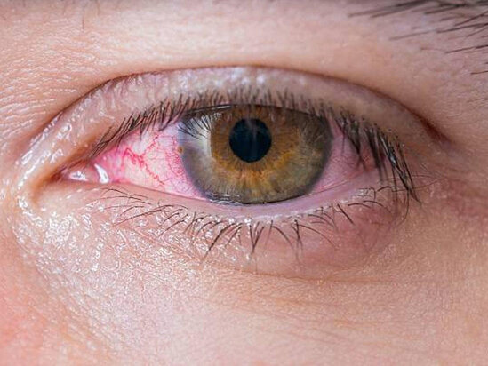 Koronavirus gözə necə təsir edir? – Həkim detalları sadaladı